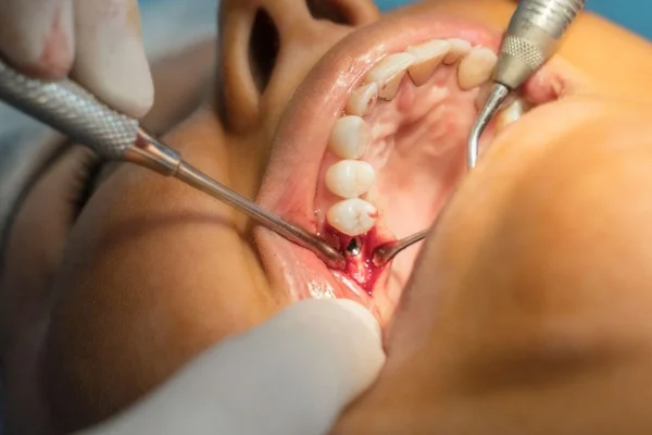 BLOODLESS-SURGERY BLOODLESS-SURGERY